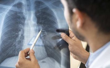 Mayo Clinic en Arizona anuncia el lanzamiento de un nuevo programa de trasplante de pulmón