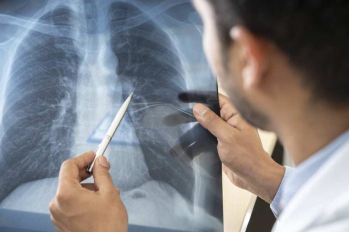 Mayo Clinic en Arizona anuncia el lanzamiento de un nuevo programa de trasplante de pulmón