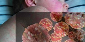 ¿Qué tanto debe preocuparnos el nuevo brote de sarampión en Latinoamérica?