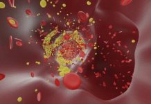 Demencia vascular: un experto de Mayo Clinic explica los problemas de los vasos sanguíneos que aumentan el riesgo de demencia Demencia vascular: un experto de Mayo Clinic explica los problemas de los vasos sanguíneos que aumentan el riesgo de demencia