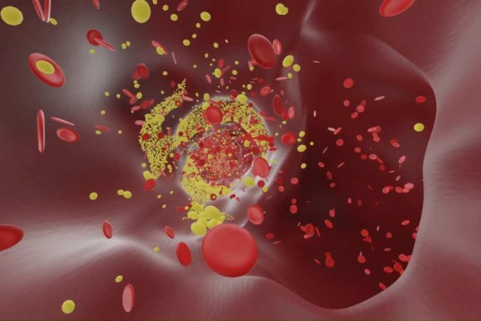 Demencia vascular un experto de Mayo Clinic explica los problemas de los vasos sanguíneos que aumentan el riesgo de demencia Demencia vascular: un experto de Mayo Clinic explica los problemas de los vasos sanguíneos que aumentan el riesgo de demencia