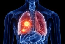El PET/CT redefine la estadificación de esta enfermedad y reduce cirugías innecesarias El PET/CT redefine la estadificación de esta enfermedad y reduce cirugías innecesarias