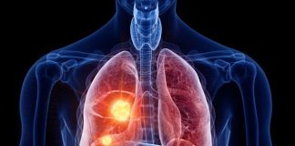 El PET/CT redefine la estadificación de esta enfermedad y reduce cirugías innecesarias