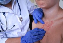 Escarlatina en el contexto escolar