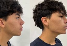 Fajas faciales: especialistas advierten sobre la moda de moldear la papada mientras se duerme Fajas faciales especialistas advierten sobre la moda de moldear la papada mientras se duerme