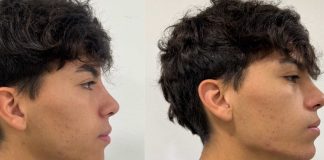 Fajas faciales especialistas advierten sobre la moda de moldear la papada mientras se duerme