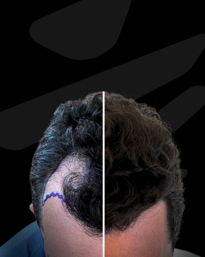 Boom de los implantes capilares en Chile Boom de los implantes capilares en Chile