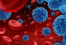 Leucemia mieloide aguda: urgencia nacional por mejorar el diagnóstico y acceso a tratamientos para pacientes Leucemia mieloide aguda: urgencia nacional por mejorar el diagnóstico y acceso a tratamientos para pacientes