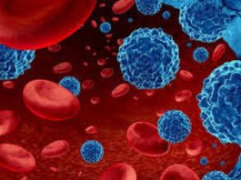 Leucemia mieloide aguda: urgencia nacional por mejorar el diagnóstico y acceso a tratamientos para pacientes Leucemia mieloide aguda: urgencia nacional por mejorar el diagnóstico y acceso a tratamientos para pacientes