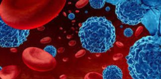 Leucemia mieloide aguda: urgencia nacional por mejorar el diagnóstico y acceso a tratamientos para pacientes