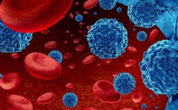 Leucemia mieloide aguda: urgencia nacional por mejorar el diagnóstico y acceso a tratamientos para pacientes