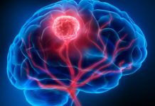 Investigadores de Mayo Clinic revelan un enfoque personalizado para el monitoreo del cáncer de cerebro Investigadores de Mayo Clinic revelan un enfoque personalizado para el monitoreo del cáncer de cerebro