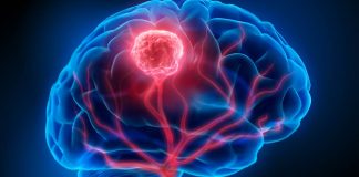 Investigadores de Mayo Clinic revelan un enfoque personalizado para el monitoreo del cáncer de cerebro