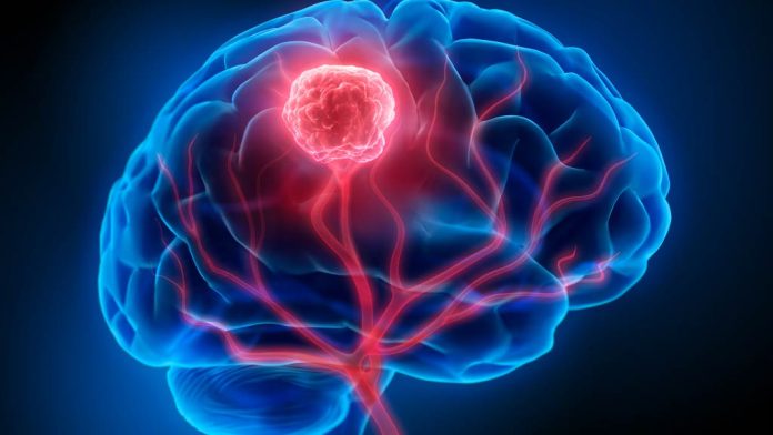 Investigadores de Mayo Clinic revelan un enfoque personalizado para el monitoreo del cáncer de cerebro Investigadores de Mayo Clinic revelan un enfoque personalizado para el monitoreo del cáncer de cerebro