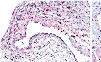 Células madre pueden ofrecer una nueva esperanza para el tratamiento de la enfermedad renal terminal Células madre pueden ofrecer una nueva esperanza para el tratamiento de la enfermedad renal terminal