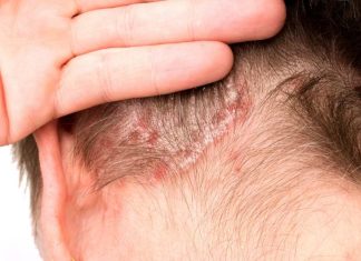 El efecto dominó más allá de la piel