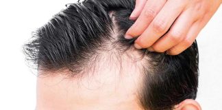 Fin al trauma de la alopecia en hombres Fin al trauma de la alopecia en hombres