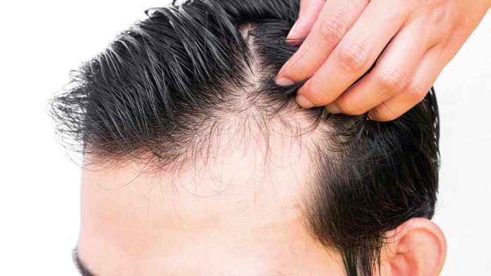 Fin al trauma de la alopecia en hombres Fin al trauma de la alopecia en hombres
