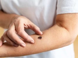 Inicio de la temporada de la araña de rincón: Cómo actuar y cuándo acudir a urgencias ante una picadura