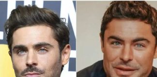 Pillow face o “cara de almohada”: qué es y cómo prevenirlo al usar rellenos faciales