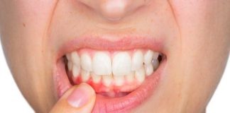 Alta mortalidad del cáncer oral puede prevenirse con controles odontológicos y autoexamen mensual 