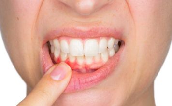 Alta mortalidad del cáncer oral puede prevenirse con controles odontológicos y autoexamen mensual 