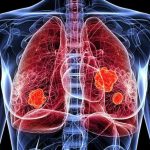 Novedades en el tratamiento del cáncer de pulmón: nuevas indicaciones alcanzaron reducciones significativas en progresión o muerte en comparación con la terapia convencional Novedades en el tratamiento del cáncer de pulmón: nuevas indicaciones alcanzaron reducciones significativas en progresión o muerte en comparación con la terapia convencional