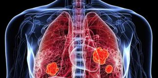 Novedades en el tratamiento del cáncer de pulmón: nuevas indicaciones alcanzaron reducciones significativas en progresión o muerte en comparación con la terapia convencional Novedades en el tratamiento del cáncer de pulmón: nuevas indicaciones alcanzaron reducciones significativas en progresión o muerte en comparación con la terapia convencional