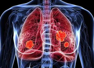 Novedades en el tratamiento del cáncer de pulmón: nuevas indicaciones alcanzaron reducciones significativas en progresión o muerte en comparación con la terapia convencional