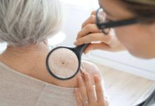 Nueva prueba genómica podría evitar que algunas personas con melanoma se sometan a la cirugía de biopsia de ganglio linfático