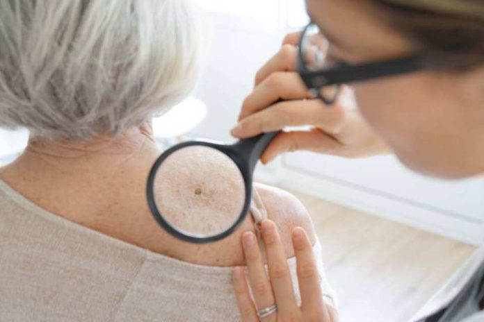 Nueva prueba genómica podría evitar que algunas personas con melanoma se sometan a la cirugía de biopsia de ganglio linfático