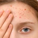 Caso de sarampión en Chile ¿Qué tan contagioso es el virus y a quiénes afecta más? Caso de sarampión en Chile ¿Qué tan contagioso es el virus y a quiénes afecta más?