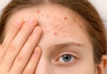 Caso de sarampión en Chile ¿Qué tan contagioso es el virus y a quiénes afecta más? Caso de sarampión en Chile ¿Qué tan contagioso es el virus y a quiénes afecta más?