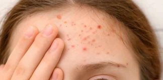 Caso de sarampión en Chile ¿Qué tan contagioso es el virus y a quiénes afecta más?