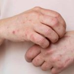 MINSAL informa caso importado de sarampión en Chile