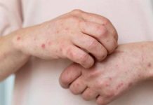 MINSAL informa caso importado de sarampión en Chile