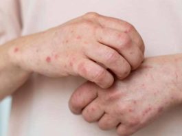 MINSAL informa caso importado de sarampión en Chile