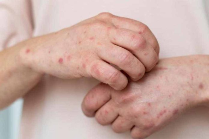 MINSAL informa caso importado de sarampión en Chile