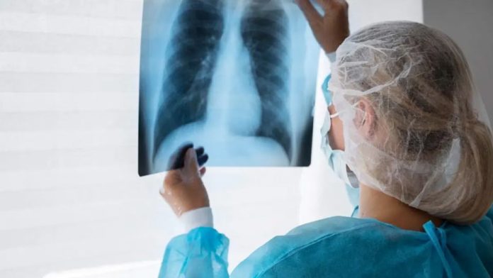 Pacientes con cáncer de pulmón quedan sin tratamiento por quiebres de stock en hospitales públicos