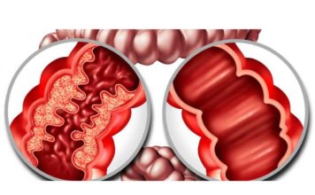 Resultados en minutos: un avance clave para el manejo de la enfermedad inflamatoria intestinal