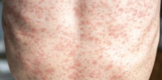 Alarma por Sarampión en Chile: ¿Qué hacer y cómo prevenir contagios? Alarma por Sarampión en Chile: ¿Qué hacer y cómo prevenir contagios?