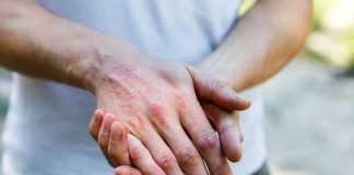 Consejos de un dermatólogo para el verano si sufres de dermatitis atópica Consejos de un dermatólogo para el verano si sufres de dermatitis atópica