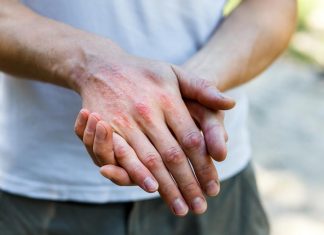 Consejos de un dermatólogo para el verano si sufres de dermatitis atópica