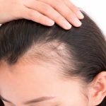 La caída del pelo no es sólo genética: estrés, malos hábitos y alimentación deficiente afectan a mujeres de cualquier edad