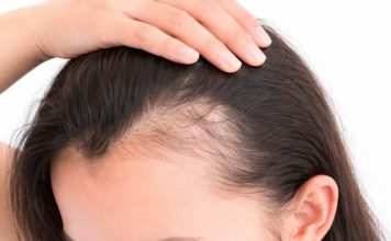 La caída del pelo no es sólo genética: estrés, malos hábitos y alimentación deficiente afectan a mujeres de cualquier edad