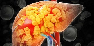 Cáncer Nuevo estudio vincula la variación genética con daños hepáticos causados por la quimioterapia en pacientes con metástasis hepáticas de cáncer colorrectal