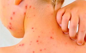 MINSAL informa caso importado de sarampión en Chile