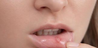 Entre el 20 % y 25 % de la población presenta aftas recurrentes: Estrés o deficiencias nutricionales entre las causas Entre el 20 % y 25 % de la población presenta aftas recurrentes: Estrés o deficiencias nutricionales entre las causas