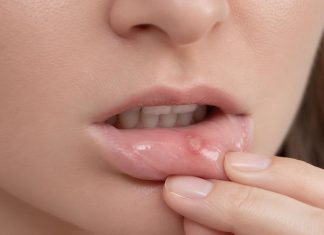 Entre el 20 % y 25 % de la población presenta aftas recurrentes: Estrés o deficiencias nutricionales entre las causas