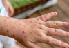 Varicela: prevenir sigue siendo fundamental Varicela: prevenir sigue siendo fundamental